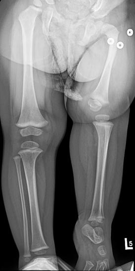 Xray showing shortening of femur, coxa vara, affected knee at higher level in case of proximal femoral focal deficiency