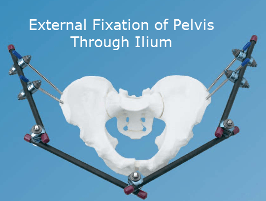 External fixation of Pelvis by Iliac Pins