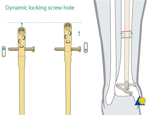 Distal Tibial Fracture,DTN Distal Tibial Nail ,Medical Device Manufacturers  -Double Medical