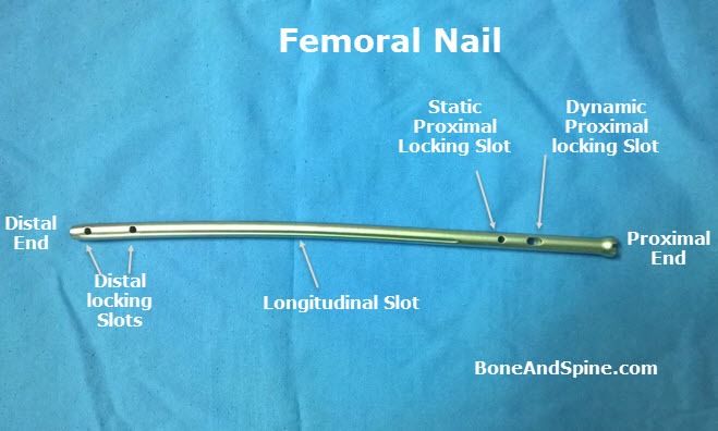 Femur - Fractures 32A_B_C 31B - Intramedullary Nailing Using the Expert  Antegrade Femoral Nail A2FN - YouTube