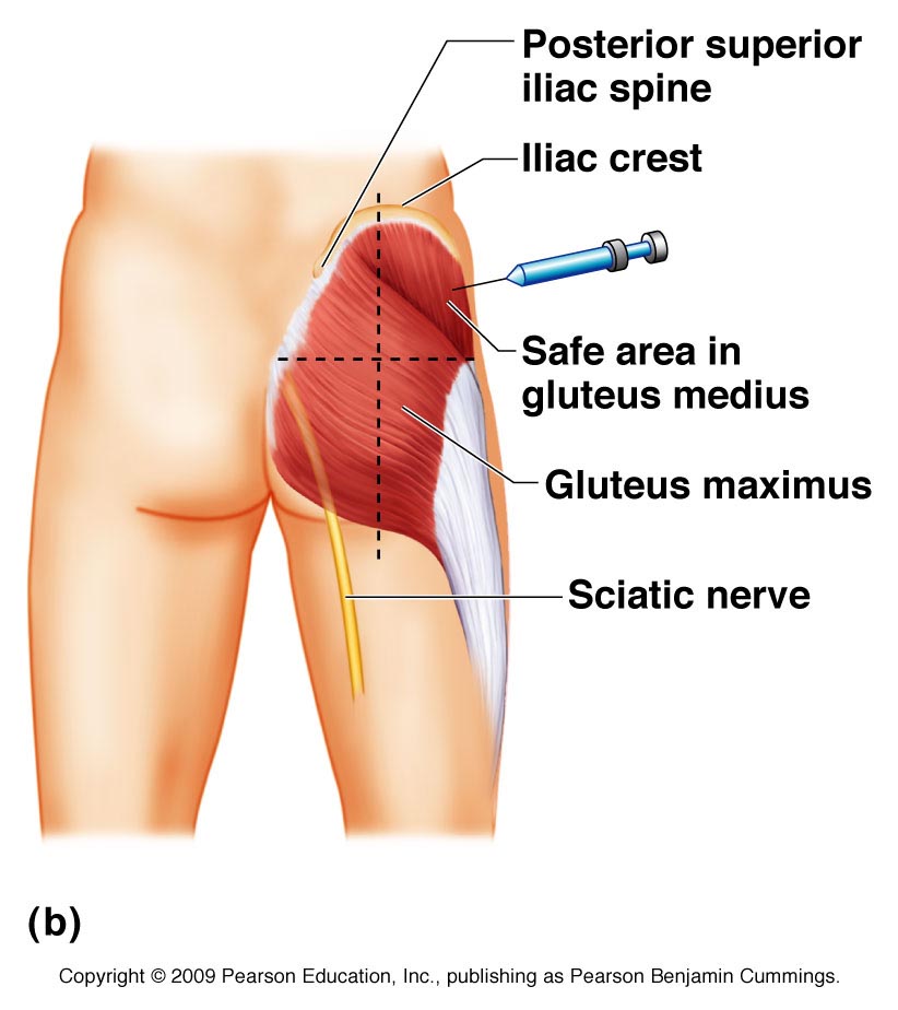 superior gluteal nerve injection