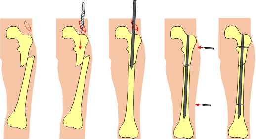 cpt code intramedullary nail intertrochanteric fracture