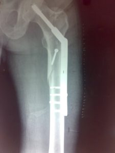 Subtroachanteric fracture fixed with derotation screw and DHS