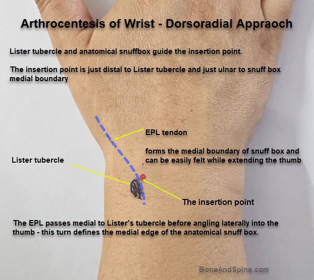 Wrist arthrocentesis dorsoradial approach