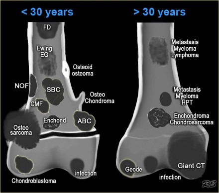 Location of musculoskeletal tumors