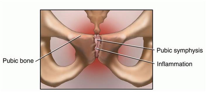 Osteitis pubis