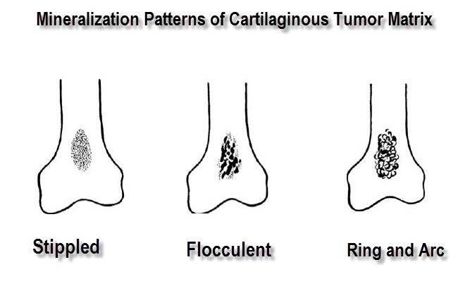 tumor mineralization patterns in cartilage matrix