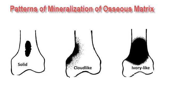 tumor mineralization patterns of osseous matirx