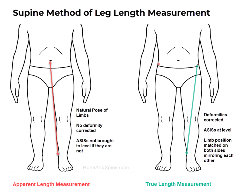 supine method of apparent and true leg length measurement