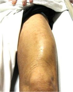 Myositis