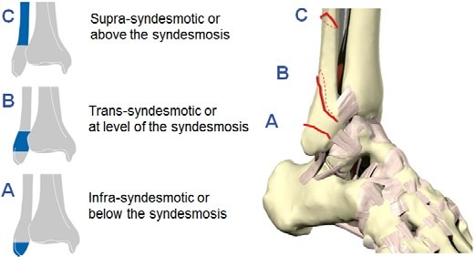 AO OTA Clssification of Malleolar Fractures