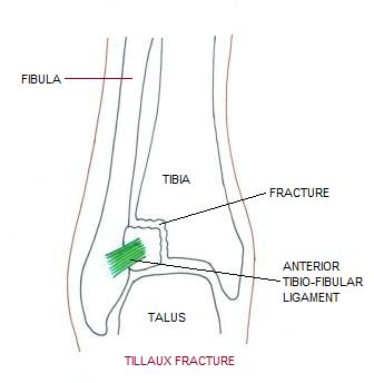 tillaux-fracture