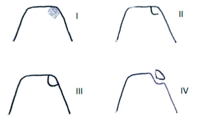 Classification of Osteochondral lesions of talus