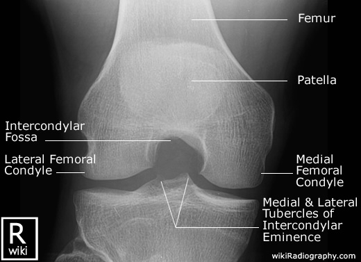 Knee X-ray PA View