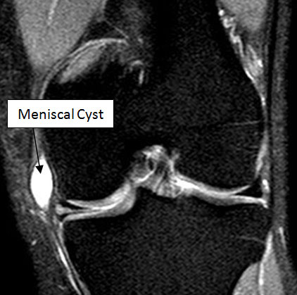 MRI Image of Meniscal Cyst