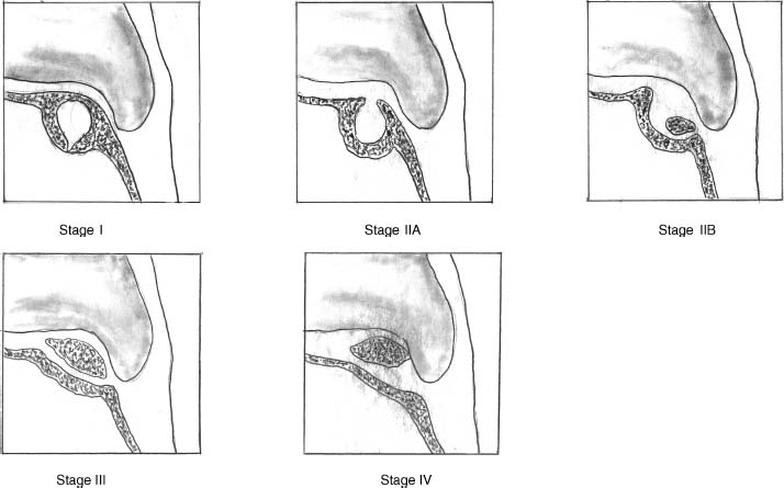 Osteochondral Lesions of Talus CT classificatn