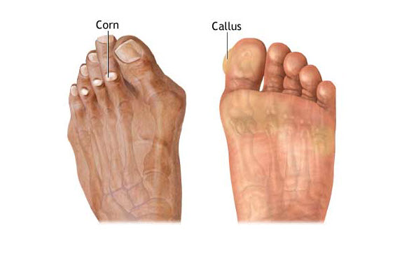 heal corns on feet