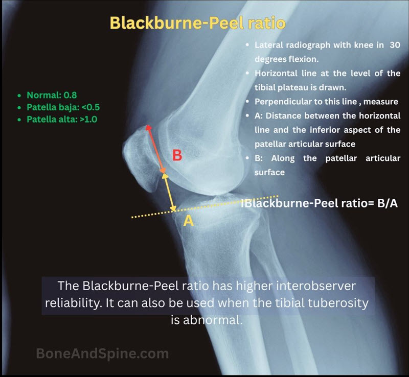 Blackburne-Peel ratio for patellar height measuring