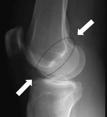 Blumensaat line on lateral view of xray knee