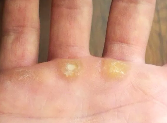 Calluses in hand