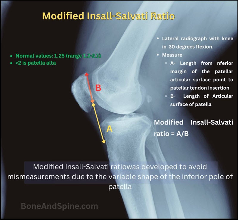 modified insall salvati ratio for patellar height measurement