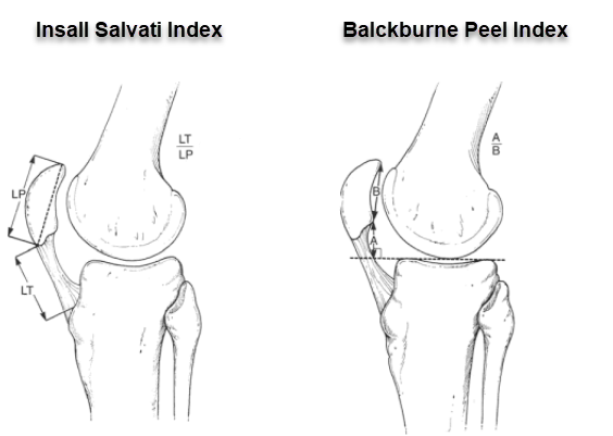 Different ratios for calculating patellar height