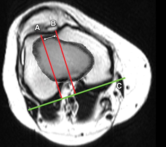 Calculation of Tibial Tuberosity - Trochlear Groove Distance or Patellar Translation