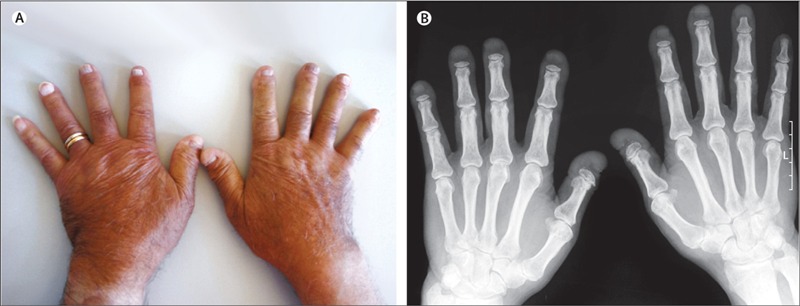 Acroosteolysis clinical image and x-rays