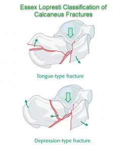 calcaneus fracture classification