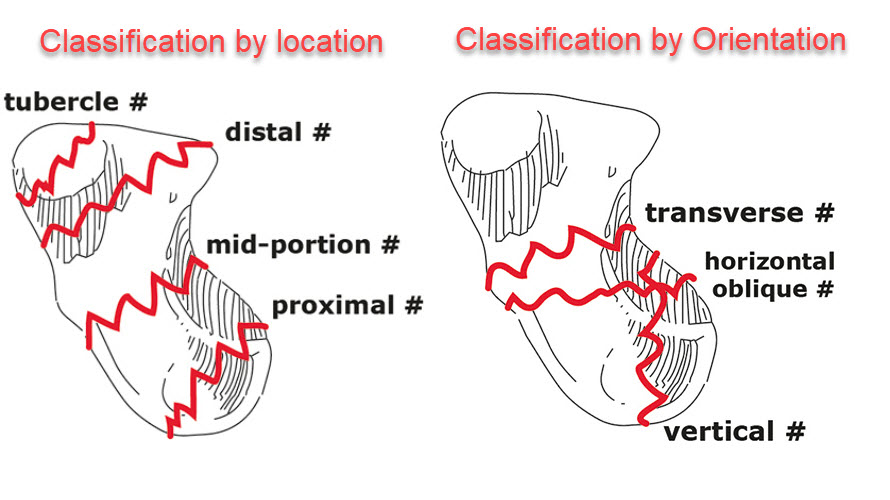 Classification of scaphoid fractures