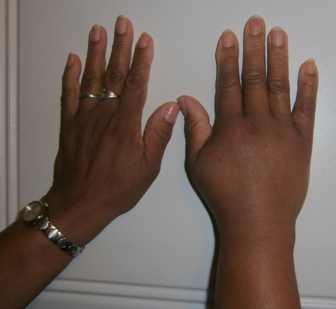 Comparative view of Palindromic Rheumatism as compared to normal