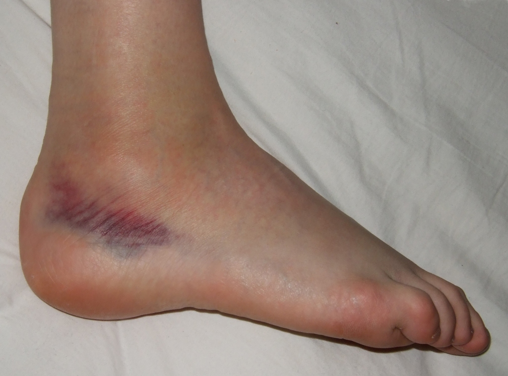 Ankle sprain of second degree