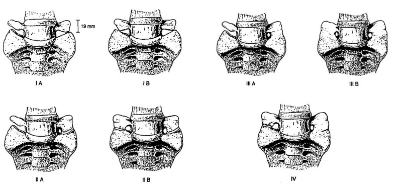 lumbarisation