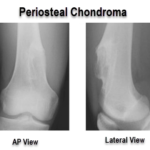 periosteal chondroma of femur