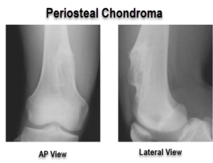 periosteal chondroma of femur