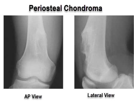 chondroma in knee x ray