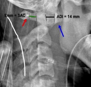 ADI and PADI in atlantoaxial instability