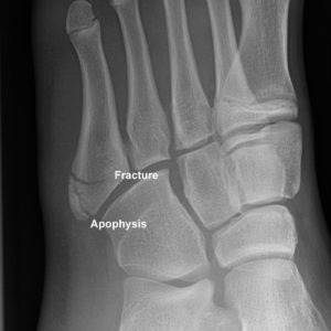 Differentiating between fifth metatrsal base fracture and apophysis