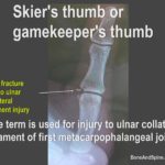 skier's thumb or gamekeeper's thumb