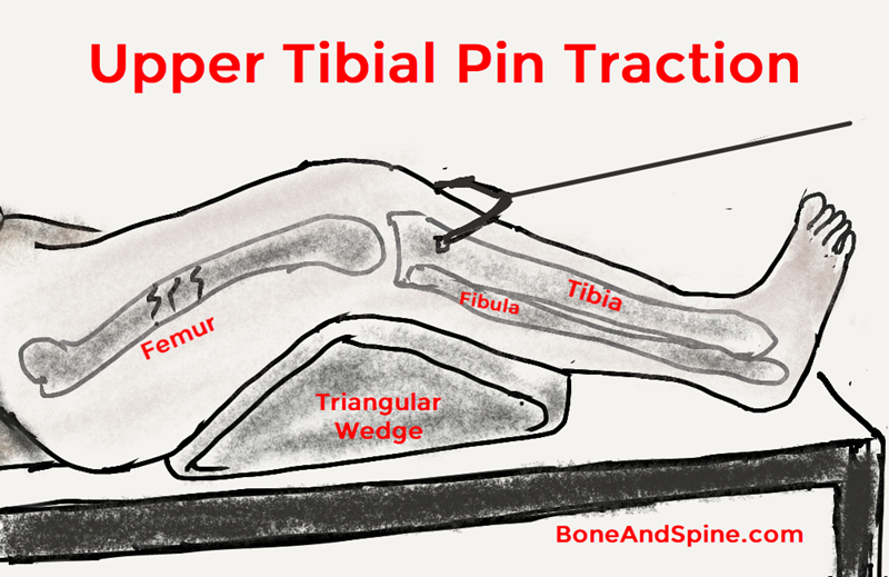skeletal traction in upper tibial pin