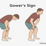 featured image of gower sign for segmenatal instability of lumbar spine